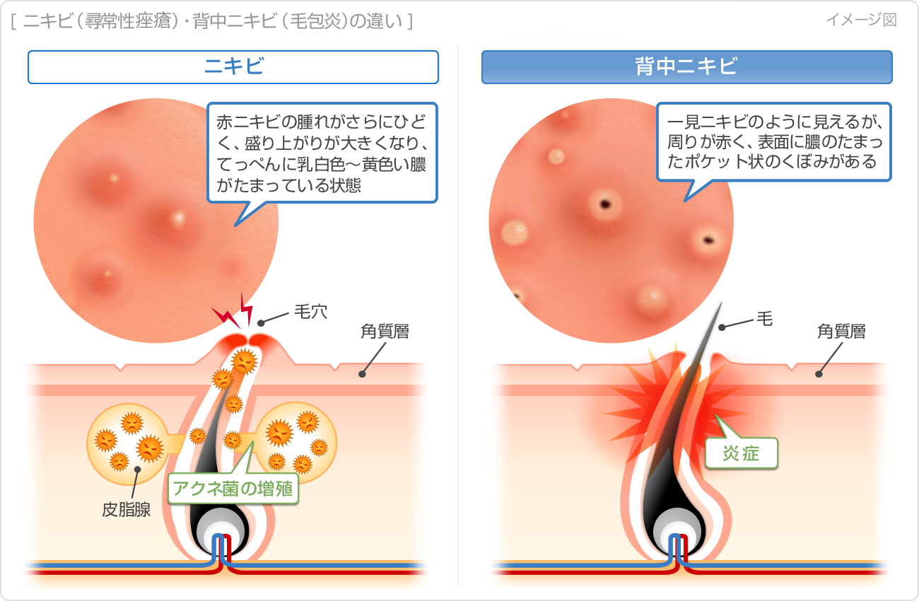 おしり ニキビ おでき