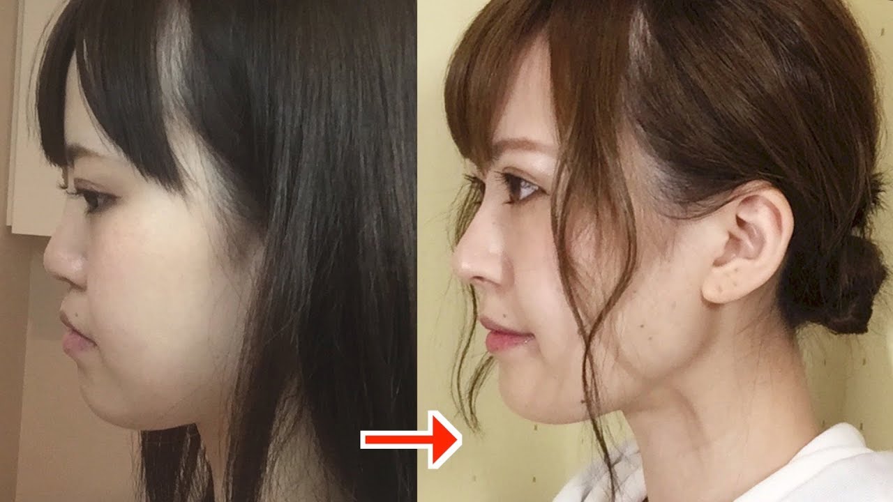 でっぱり ん 整形 前