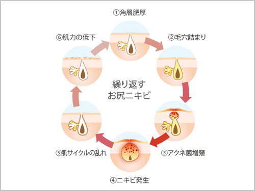 おしり ニキビ おでき